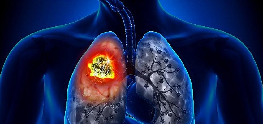 Akciğer Kanseri Dünya Genelinde En Sık Görülen Kanser Türü