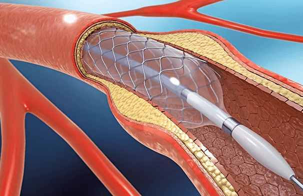 Stent Tedavisi Nedir?